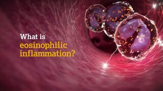 Eosinophilic Inflammation | Our Therapy Areas |AstraZeneca